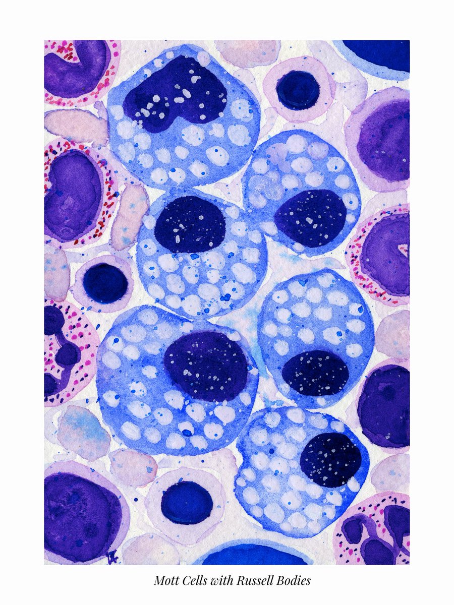 path_girl88's tweet photo. Continuing my spooky cells series and coincidentally board study topics with Flame cells and Mott cells π. #pathology #pathx #hemepath #pathtwitter #pathart https://t.co/uJIxAsh9o7