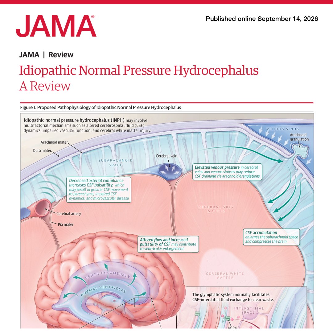 JAMA_current's tweet photo. 📝 #JAMAReview: #Idiopathic normal pressure hydrocephalus is a progressive neurologic disorder in older adults associated with gait impairment and often urinary dysfunction and cognitive decline.

🔗 Learn more: https://t.co/lLSUIHQScA https://t.co/m97IlTfTQ1