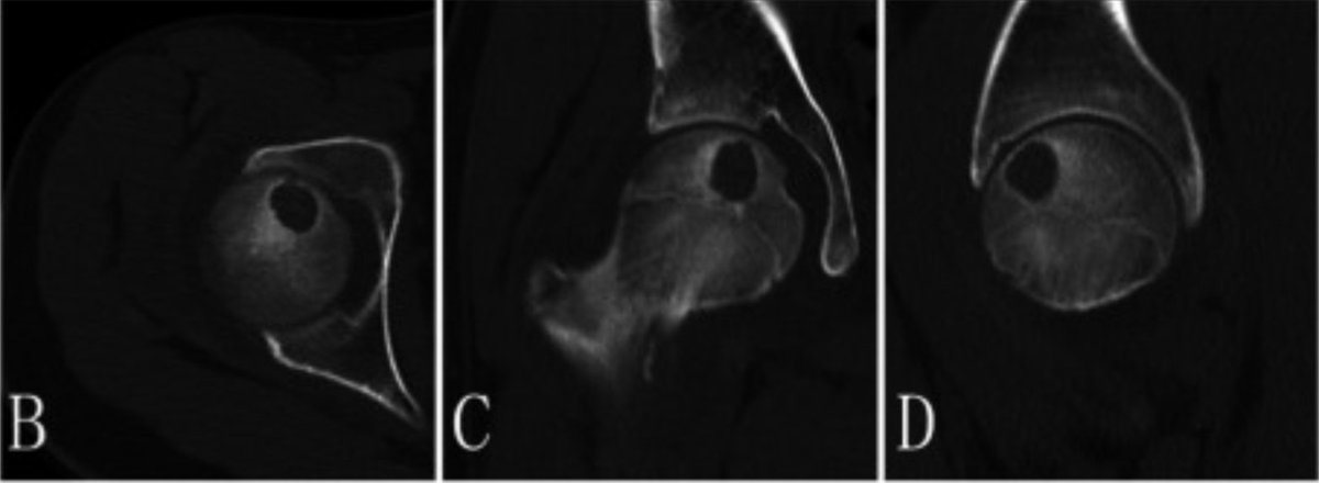 jppathpd's tweet photo. Dx? femur HE #Pathkeys 2024-1p-25 (etc) https://t.co/hilRpVqeWY