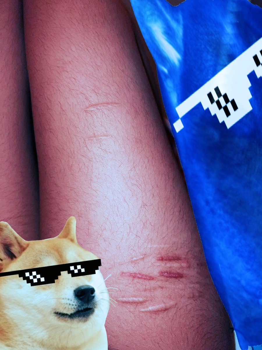 eunnibuni's tweet photo. healed scars‼️
euuuggg why are they so ugly bro :// https://t.co/V4U8c6keZY