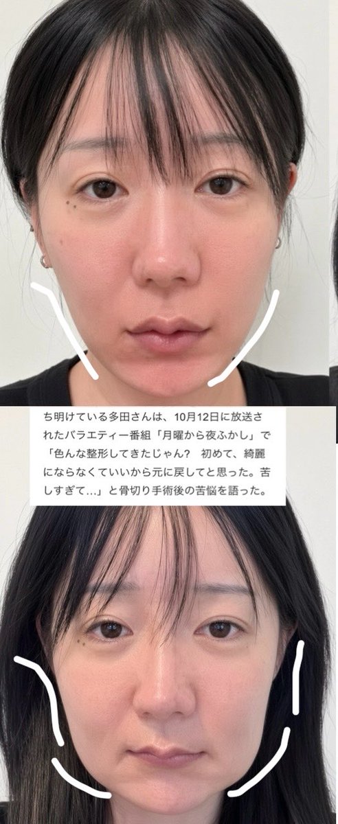 3b2zg's tweet photo. 【悲報】辻希美さん、両顎手術を行う模様

40歳での骨切りは相当な輪郭弛みリスクがあることは確かで、フェフ姉さんの多田さんの様にフェイスラインの土砂崩れが起こる可能性も十分あり得る。

ディープバイトとは言え、今の顔を変えてまで骨切りするリスクリターンはどうなのかという意見で溢れかえる https://t.co/d74D4ZHC0k