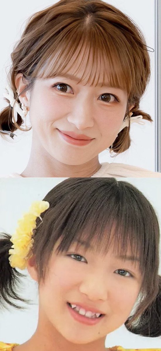 3b2zg's tweet photo. 【悲報】辻希美さん、両顎手術を行う模様

40歳での骨切りは相当な輪郭弛みリスクがあることは確かで、フェフ姉さんの多田さんの様にフェイスラインの土砂崩れが起こる可能性も十分あり得る。

ディープバイトとは言え、今の顔を変えてまで骨切りするリスクリターンはどうなのかという意見で溢れかえる https://t.co/d74D4ZHC0k