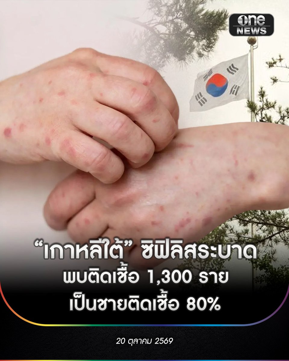 onenews31's tweet photo. 20 ต.ค. 69 เพจเฟซบุ๊ก "สะใภ้โซลอินโทรเวิร์ต" เผยแพร่ข้อมูลทางการแพทย์และรายงานข่าวจากสื่อเกาหลีใต้ TV Chosun ระบุว่า เกาหลีใต้กำลังเผชิญกับการแพร่ระบาดของ "โรคซิฟิลิส" โดยตั้งแต่ต้นปีถึงวันที่ 19 สิงหาคม 2026 มีรายงานพบผู้ป่วยทั่วประเทศแล้วสูงถึง 1,300 ราย ในจำนวนนี้มี 121 รายที่เป็นการติดเชื้อมาจากต่างประเทศ
.
สำหรับพื้นที่กรุงโซล พบว่าในบรรดาโรคติดต่อที่รับเชื้อมาจากต่างประเทศทั้งหมด 83 กรณี เป็นโรคซิฟิลิสสูงถึง 39 กรณี ซึ่งถือเป็นสัดส่วนที่มากที่สุด ทั้งนี้ ย้ำชัดว่าคำว่า "ติดเชื้อจากต่างประเทศ" หมายถึงการรับเชื้อขณะอยู่ต่างประเทศ ไม่ได้หมายความว่าผู้ป่วยเป็นชาวต่างชาติทั้งหมด หรือติดจากการท่องเที่ยวทั่วไป นอกจากนี้ ตัวเลขย้อนหลังพบว่าผู้ป่วยราว 8 ใน 10 (78%) เป็นผู้ชาย และเกือบ 6 ใน 10 อยู่ในกลุ่มอายุ 20–39 ปี
.
สิ่งที่น่ากังวลที่สุดคือ ผู้ติดเชื้อบางคนมีอาการน้อยจนไม่รู้ตัว โดยแผลซิฟิลิสในระยะแรกมัก "ไม่เจ็บ" และสามารถหายไปได้เอง ทำให้หลายคนเข้าใจผิดว่าหายแล้ว แต่แท้จริงแล้วเชื้อยังคงอยู่ในร่างกาย หากปล่อยไว้โดยไม่รักษา อาจพัฒนาไปสู่ระยะที่มีผื่นขึ้นตามตัว ฝ่ามือ ฝ่าเท้า หรือเข้าสู่ระยะสงบ และหากปล่อยไว้นานอาจเกิดภาวะแทรกซ้อนรุนแรง ทำลายสมอง ดวงตา และหัวใจได้
.
ผู้เชี่ยวชาญเน้นย้ำให้ใช้ถุงยางอนามัยทุกครั้งเพื่อลดความเสี่ยง แม้จะยังมีโอกาสติดเชื้อหากสัมผัสโดนแผลที่อยู่นอกบริเวณถุงยางก็ตาม หากมีพฤติกรรมเสี่ยง คู่นอนตรวจพบเชื้อ หรือมีแผล-ผื่นผิดปกติ ควรรีบพบแพทย์ทันที อย่ารอให้อาการหนักหรืออายที่จะตรวจ เพราะโรคซิฟิลิสสามารถรักษาให้หายขาดได้ด้วยยาที่เหมาะสม หากตรวจพบเร็วก็ยิ่งรักษาได้เร็ว
.
#สำนักข่าววันนิวส์
#onenews