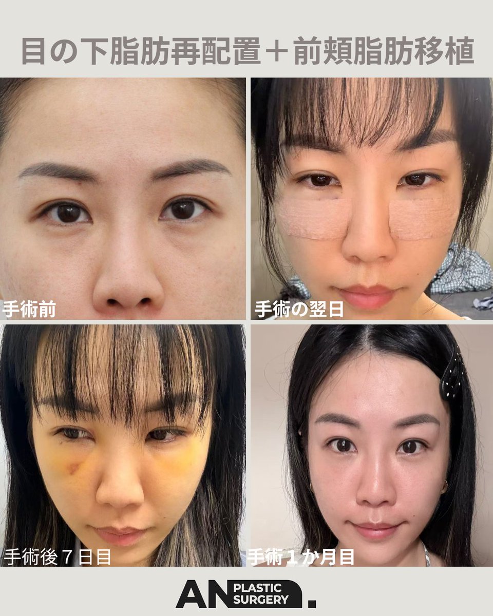 and_ps_eye's tweet photo. ✨お客様のリアルな術後レビュー✨

目の下の脂肪再配置で、気になっていた目の下のふくらみ・クマを自然に改善👀
実際のお客様のリアルな感想をご紹介します♡
自然で若々しい目元へ。

目の下のお悩みも、ぜひANDにご相談ください🤍
https://t.co/aL4LSlnuZX

#目の下脂肪再配置  #目の下のクマ  #目の下のたるみ #クマ取り  #韓国美容  #韓国整形  #韓国美容整形  #AND美容外科　＃韓国美容外科　＃渡韓整形　＃裏ハムラ　＃目元美人