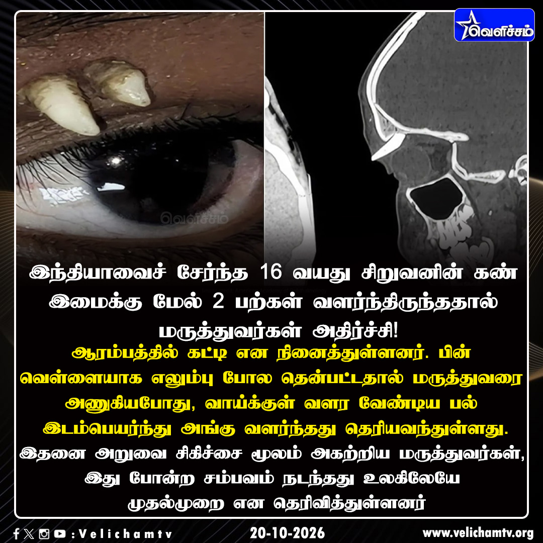 velichamtvtamil's tweet photo. கண்ணுக்கு மேல் பல்!
#EctopicTooth #VelichamTV https://t.co/61gKF0Eygq