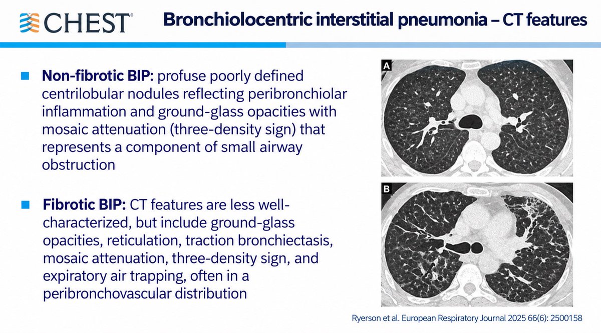 georgepapadapol's tweet photo. El término nuevo más destacado y controversial fue el patrón de neumonía intersticial bronquiolocéntrica (BIP) visto más frecuentemente en neumonitis por hipersensibilidad #CHEST2026 https://t.co/V5pQuEz2vB