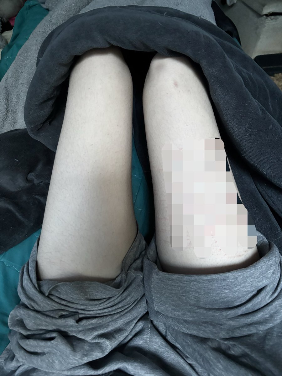 cvepie's tweet photo. ᥫ᭡.ִֶָ𓂃       april                             now  ⊹₊⟡⋆
     not much of a difference (＞人＜;)
#thinspo #edrtwt #ricecaketwt #editwt #bc #hungrytwt #bmi15 #comparisonspo https://t.co/u5nvFsbrOe