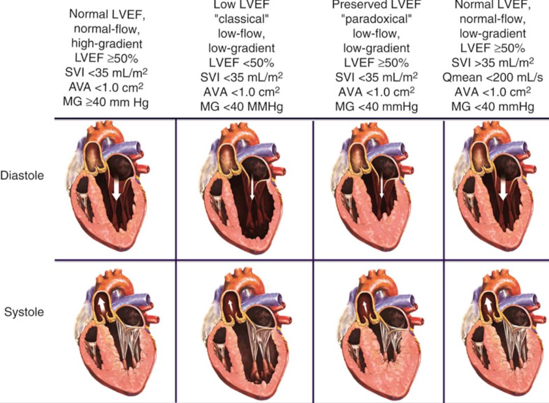 TrackYourHeart's tweet photo. SEVERE AORTIC STENOSIS: THE GRADIENT CAN BE MISLEADING

An aortic valve area ≤1.0 cm² suggests severe aortic stenosis (AS), but the mean gradient may be below 40 mmHg.
The gradient depends on blood flow, not just valve narrowing.

1. High-gradient AS
- AVA ≤1.0 cm²
- Mean gradient ≥40 mmHg
- Usually preserved or reduced LVEF

2. Classical low-flow, low-gradient AS
- AVA ≤1.0 cm²
- Mean gradient <40 mmHg
- LVEF <50%
- Stroke volume index ≤35 mL/m²

3. Paradoxical low-flow, low-gradient AS
- AVA ≤1.0 cm²
- Mean gradient <40 mmHg
- LVEF ≥50%
- Stroke volume index ≤35 mL/m²

4. Normal-flow, low-gradient AS
- AVA ≤1.0 cm²
- Mean gradient <40 mmHg
- LVEF ≥50%
- Stroke volume index >35 mL/m²

Why this matters: Low flow can conceal the hemodynamic severity of a stenotic valve. Discordant findings require careful assessment of Doppler measurements, blood pressure, flow state and valve anatomy.

In classical low-flow AS, dobutamine stress echocardiography can help distinguish true severe from pseudo-severe AS. CT aortic valve calcium scoring can help when severity remains uncertain.

Clinical pearl: Never grade AS using the valve area or gradient alone. Integrate AVA, mean gradient, peak velocity, stroke volume, LVEF and clinical context.

Reference: 2025 ESC/EACTS Guidelines for the Management of Valvular Heart Disease.