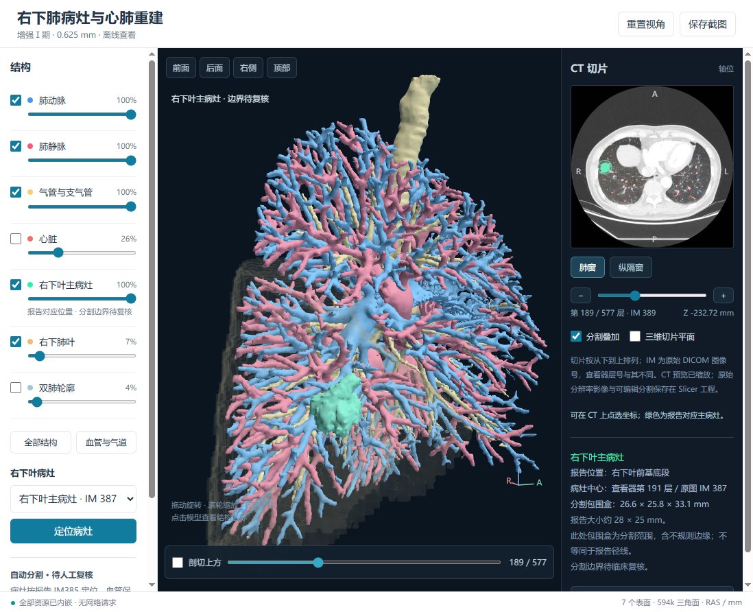 xuzhican's tweet photo. 肺结节三维重建完全没问题啊！很完善了 https://t.co/2l738fCcnZ