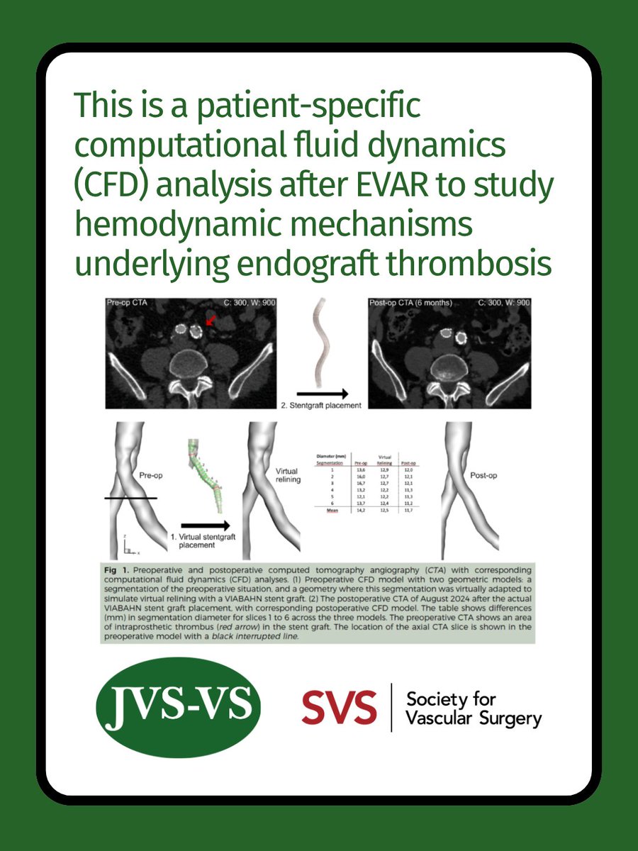 JVS_VascSci's tweet photo. 📣From the current issue: Scheepmaker et al. used computational fluid dynamics to study hemodynamics leading to EVAR limb thrombosis.
READ MORE at https://t.co/gkZi38Ix8y
#AAA #EVAR #CFD #vascularscience
@VascularSVS https://t.co/umri71icIC
