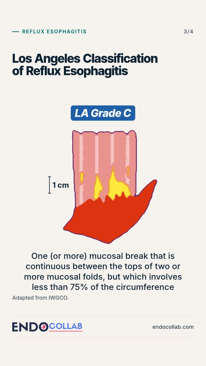 EndoCollabcom's tweet photo. Los Angeles Classification of Reflux Esophagitis.
 
Grades A to D are defined by:
The length of the mucosal break
Whether it extends between the tops of mucosal folds
Whether it involves at least 75% of the esophageal circumference
 
Adapted from IWGCO. https://t.co/kicHnUxHM7