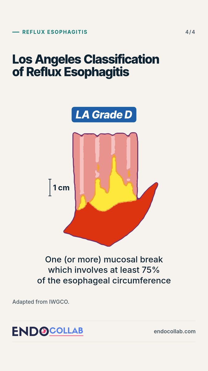 EndoCollabcom's tweet photo. Los Angeles Classification of Reflux Esophagitis.
 
Grades A to D are defined by:
The length of the mucosal break
Whether it extends between the tops of mucosal folds
Whether it involves at least 75% of the esophageal circumference
 
Adapted from IWGCO. https://t.co/kicHnUxHM7