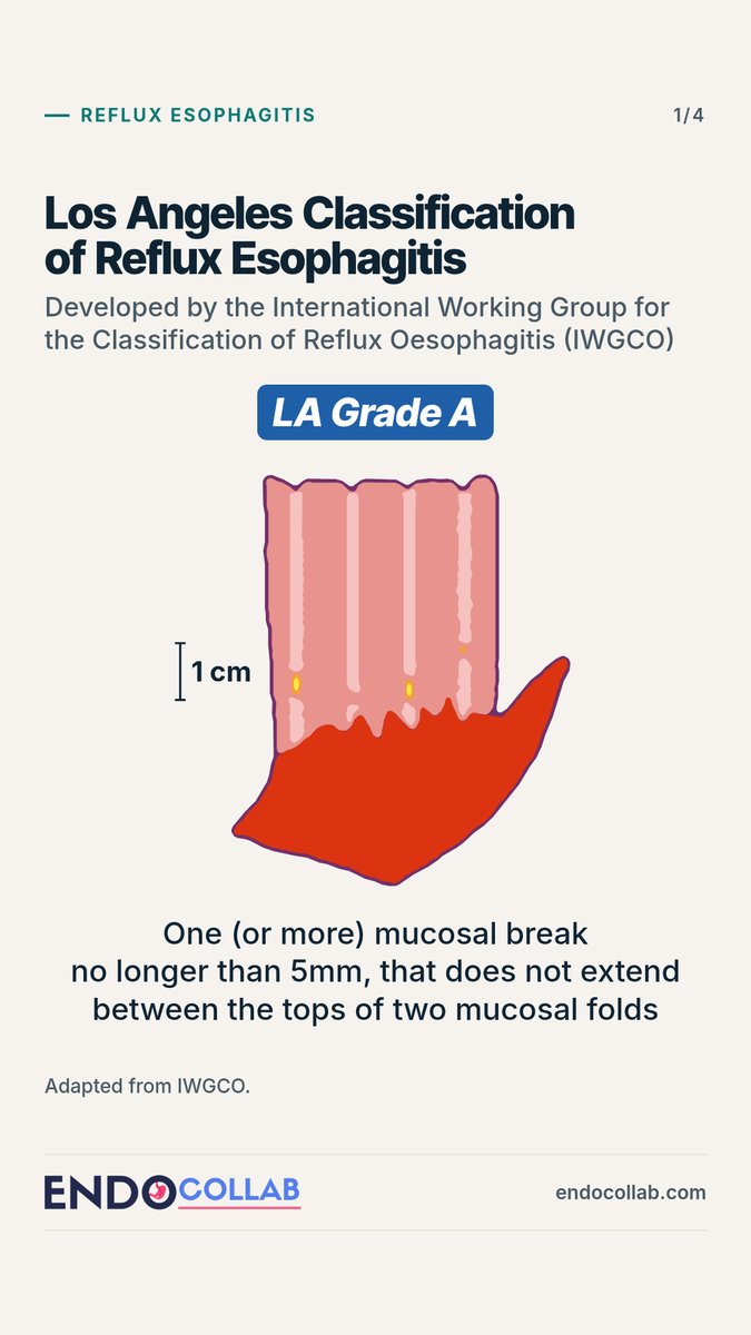 EndoCollabcom's tweet photo. Los Angeles Classification of Reflux Esophagitis.
 
Grades A to D are defined by:
The length of the mucosal break
Whether it extends between the tops of mucosal folds
Whether it involves at least 75% of the esophageal circumference
 
Adapted from IWGCO. https://t.co/kicHnUxHM7
