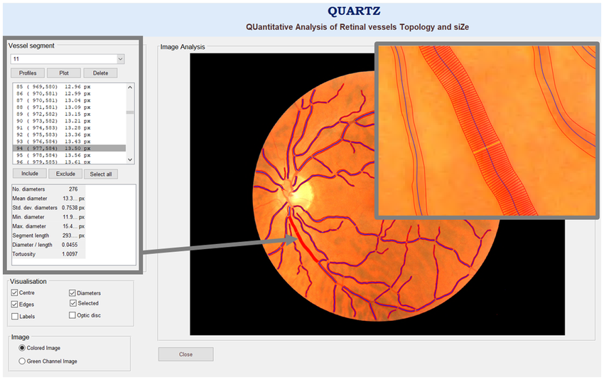 revoptom's tweet photo. Certain Retinal Vessel Traits May Signal Balance Impairment

Narrower arterioles and wider venules were linked to a greater risk of developing this problem over three years of follow-up. Read the story: https://t.co/Gcadw1xkVM

#optometry #optometrist #eyecare #retina https://t.co/AvCNJ2hjzs
