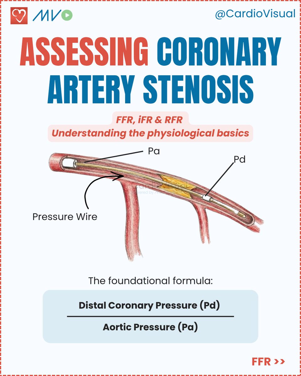 CardioVisualApp's tweet photo. A narrowing on the angiogram doesn't always mean the heart is starved of blood.

A quick guide to FFR, iFR, and RFR, the three ways we measure whether a lesion actually limits flow. Save the comparison 📌

Follow @CardioVisual for more cardiology made simple. https://t.co/inrZHrP4hW