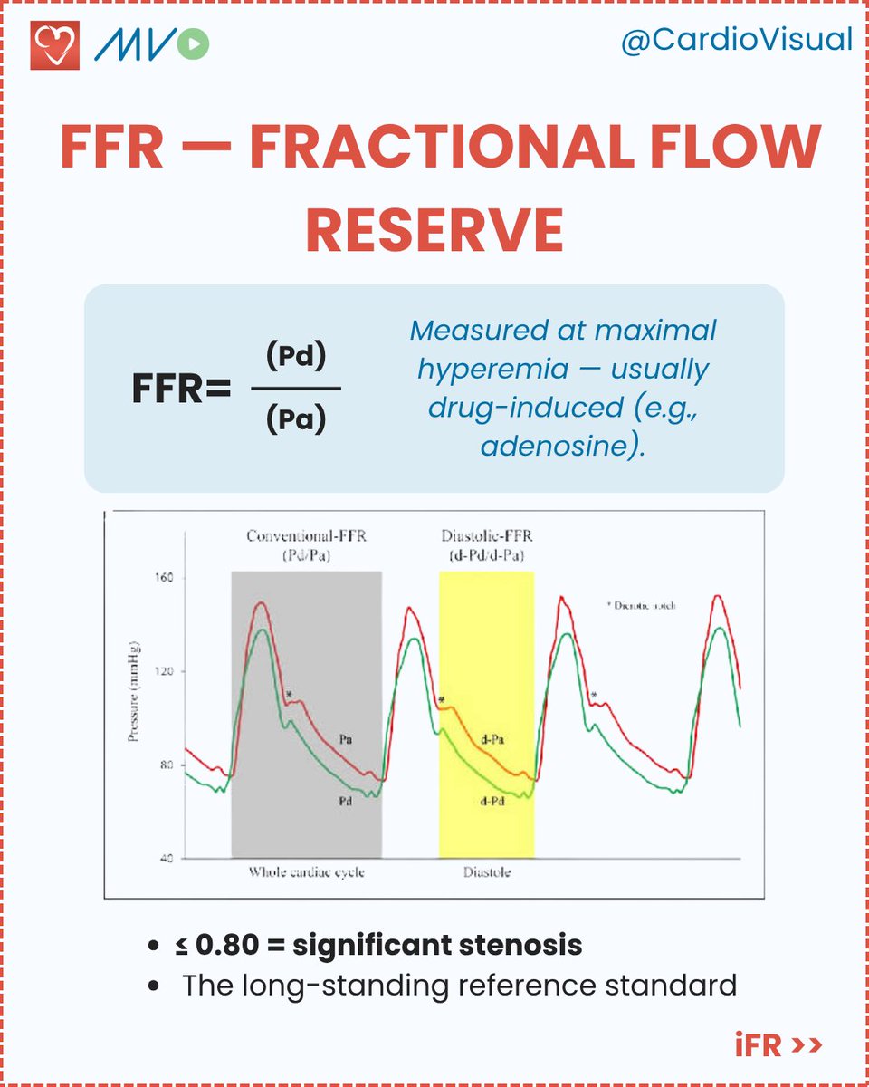 CardioVisualApp's tweet photo. A narrowing on the angiogram doesn't always mean the heart is starved of blood.

A quick guide to FFR, iFR, and RFR, the three ways we measure whether a lesion actually limits flow. Save the comparison 📌

Follow @CardioVisual for more cardiology made simple. https://t.co/inrZHrP4hW