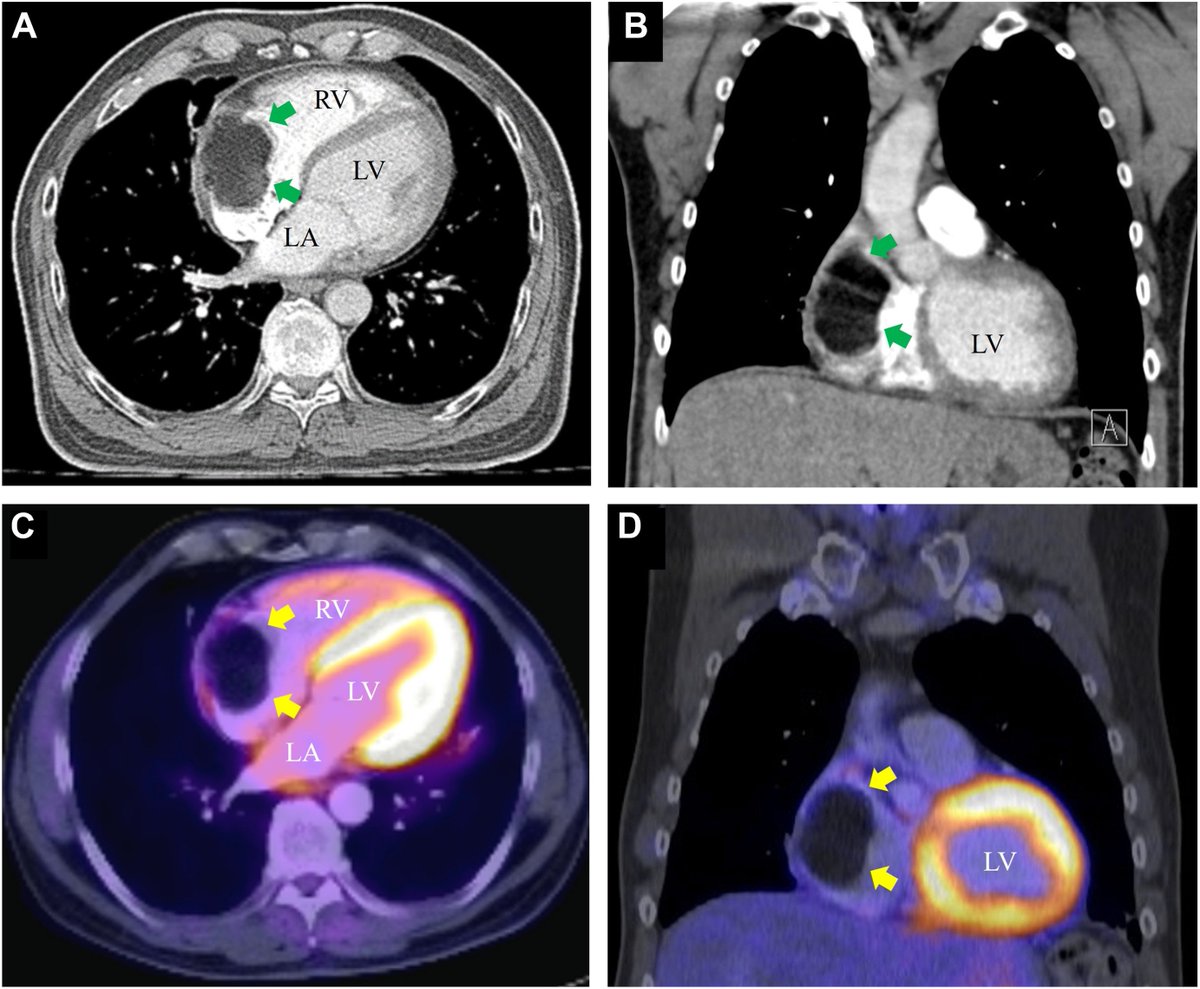 VLSorrellImages's tweet photo. #JADEL

CASE reports and CASE series are being published #fastNfurious: here's a few of the most recent:

Massive Right Atrial Lipoma Complicated by Atrial Flutter, Tachycardia-Induced Cardiomyopathy, and Cardioembolism

https://t.co/yoUPOcSNdC
@ASE360 @CASEfromASE https://t.co/l6jhEPlnnE