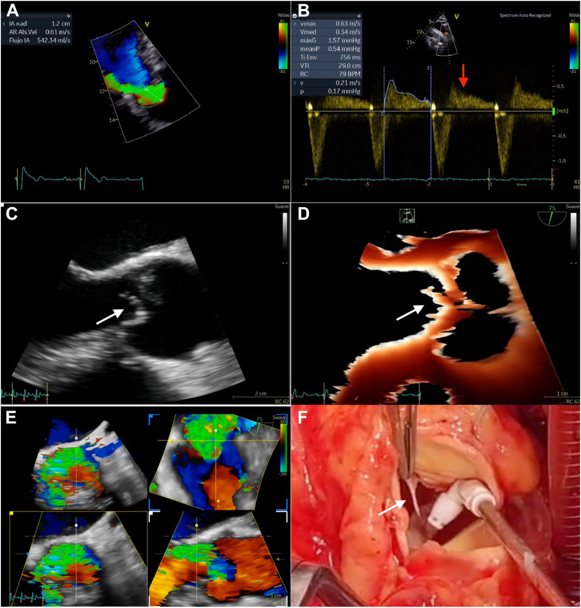 VLSorrellImages's tweet photo. #JADEL

CASE reports and CASE series are being published #fastNfurious: here's a few of the most recent:

Ruptured Rudimentary Aortic Chordae Tendineae Causing Acute Severe Aortic Regurgitation

https://t.co/yoUPOcSNdC
@ASE360 @CASEfromASE https://t.co/tvHTToLkpT