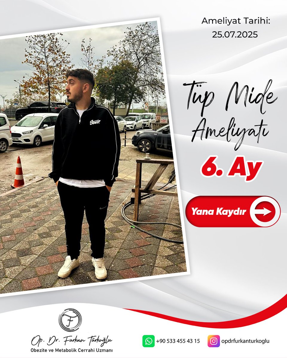 dr_fturkoglu's tweet photo. Tüp Mide Ameliyatı 6.ay kontrol

📞+90 5017454345
https://t.co/L74dYPWW7a
https://t.co/KXkN7jXXsh
https://t.co/QWBuDtraRy
https://t.co/CAXv48zSk7
https://t.co/25K1r4MdTi

#obezite #tüpmide #kocaelitüpmide  #obezitecerrahi  #midebalonu #gastricsleeve #sleevegastrectomy #obesity https://t.co/sD5R0ragGh