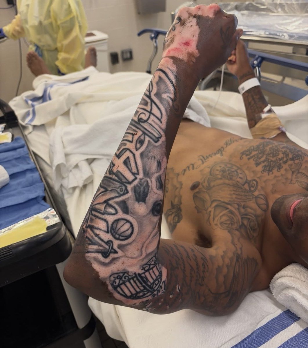 memeislifeeasy's tweet photo. Este chico sobrevivió por suerte a una descarga mortal al tocar un poste eléctrico y así quedó su brazo, dándole un nuevo aspecto a sus tatuajes https://t.co/3hrLaBi8y4