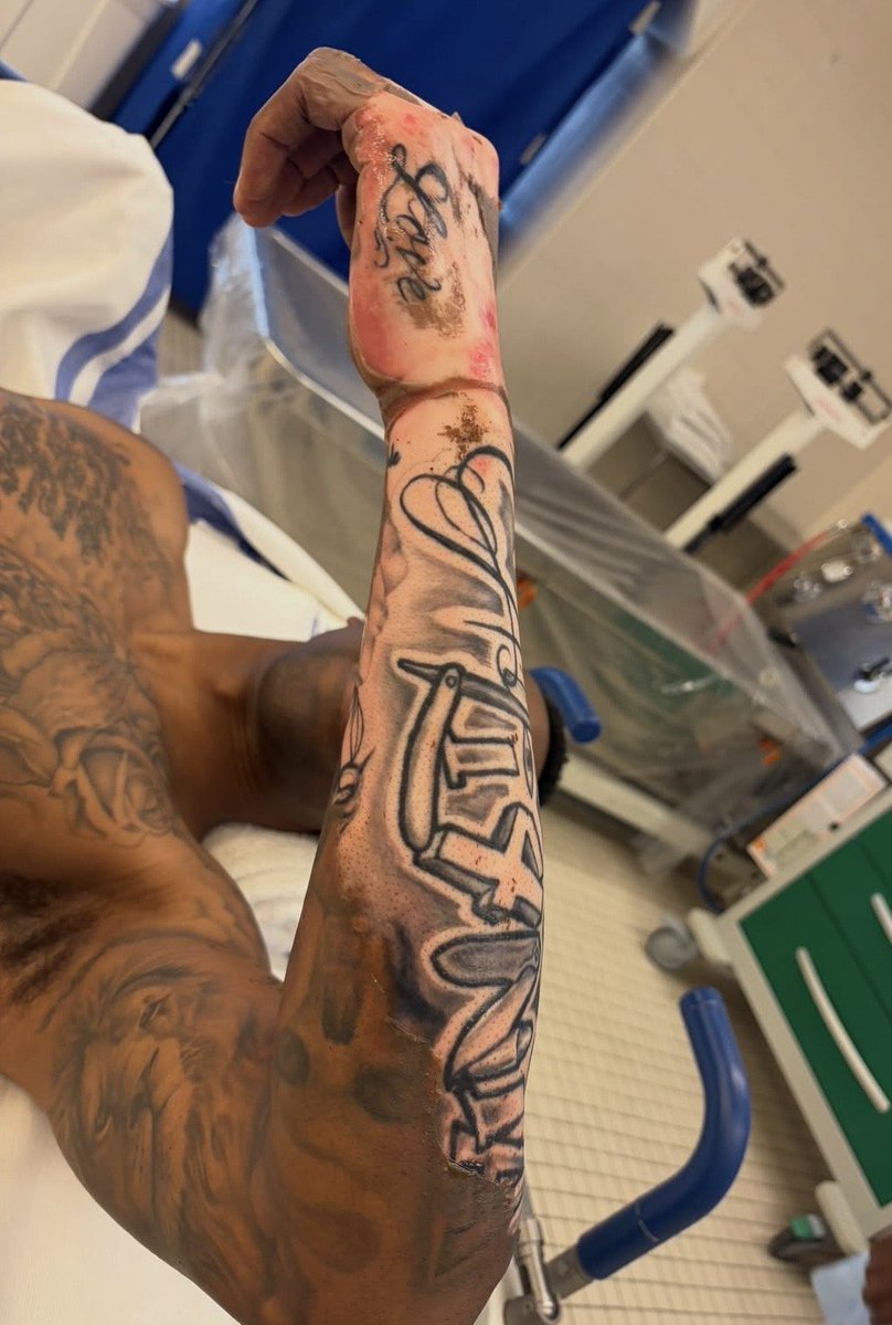 memeislifeeasy's tweet photo. Este chico sobrevivió por suerte a una descarga mortal al tocar un poste eléctrico y así quedó su brazo, dándole un nuevo aspecto a sus tatuajes https://t.co/3hrLaBi8y4
