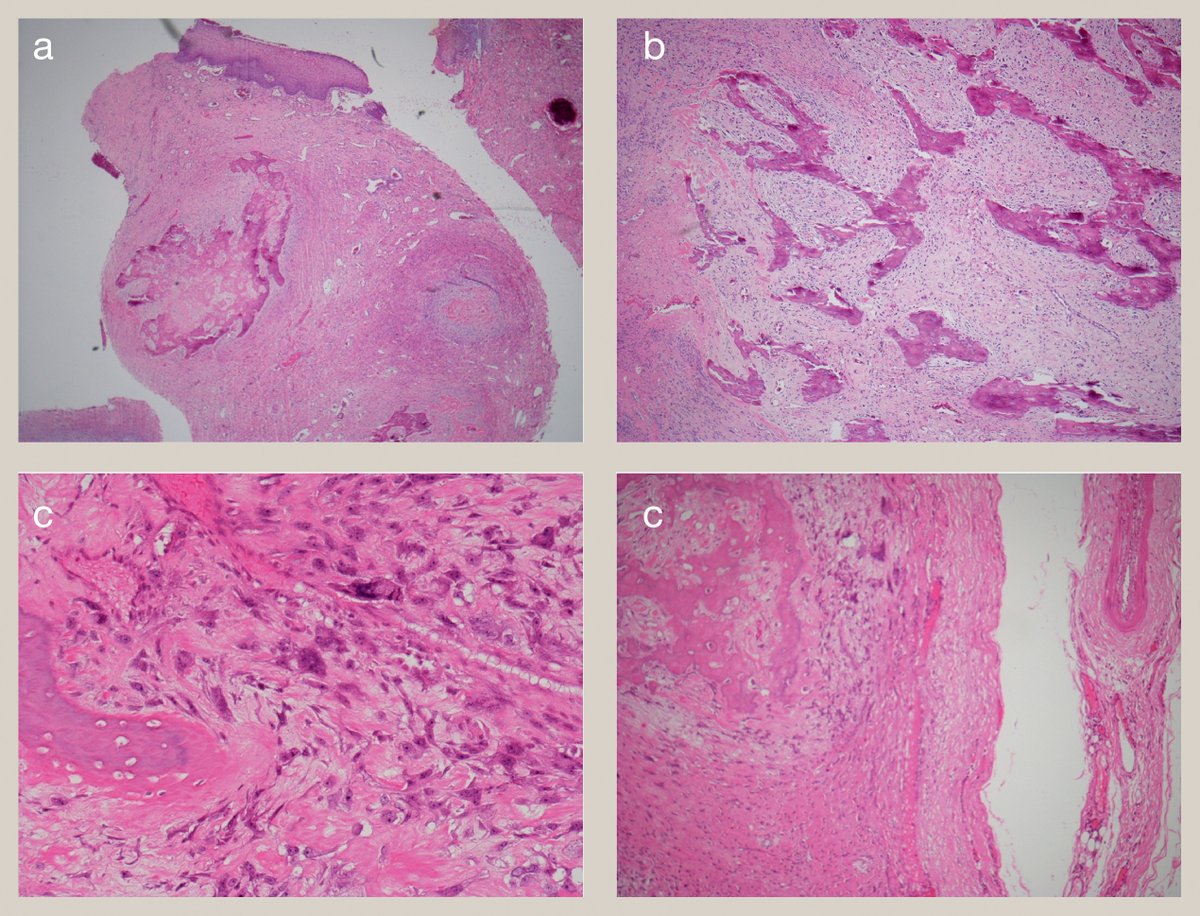pathsoc's tweet photo. 📷 Don't forget to check out the October edition of Diagnostic Histopathology: mini-symposium on Tumours of Soft Tissue and Bone

Histology image below is from our trainee-run case of the month 🔬

https://t.co/oVJlxraK5S https://t.co/htibAN8Az7