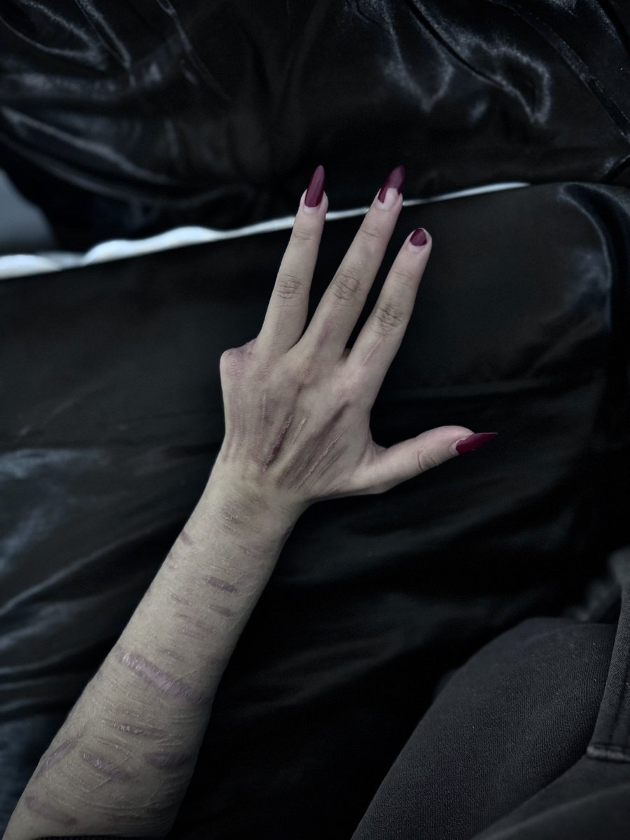SkeletalSirenXx's tweet photo. im the girl who cut off circulation to a finger shrtwt https://t.co/EyNWRgFdVH