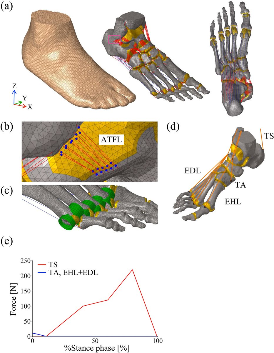 ABMEjournal's tweet photo. Foot pain and walking disorders can be difficult to treat in part because clinicians still lack a precise grasp of how the foot’s intricate structure manages load with every step.

To better understand this mechanical complexity, researchers developed a 3D finite element model of the human foot capable of forward dynamic simulation during the stance phase of walking.

Unlike simplified musculoskeletal models, this anatomically detailed representation incorporated bones, soft tissues, ligaments, and the plantar aponeurosis, and was driven by experimentally measured tibial motion and estimated muscle forces. The simulations closely matched experimental ground reaction forces, plantar pressure patterns, and bone kinematics, while also enabling estimation of internal stresses and strains that cannot be measured directly in vivo.

By illuminating how internal foot structures bear and distribute forces, this framework could support improved orthotic design, surgical planning, and prevention strategies that reduce pain and preserve mobility over the long term.

𝗥𝗲𝗮𝗱 𝗺𝗼𝗿𝗲: https://t.co/QIEe21UUjm

𝗦𝘁𝘂𝗱𝘆: Simulating Human Foot Mechanics During Walking Based on an Anatomically Detailed Forward Dynamic Finite Element Model

𝗔𝘂𝘁𝗵𝗼𝗿𝘀: Kohta Ito, Yuka Matsumoto, Hiroyuki Seki, Takeo Nagura, and Naomichi Ogihara

𝗦𝘂𝗯𝗺𝗶𝘁 𝘆𝗼𝘂𝗿 𝗺𝗮𝗻𝘂𝘀𝗰𝗿𝗶𝗽𝘁: https://t.co/Gyz8DNneUg
