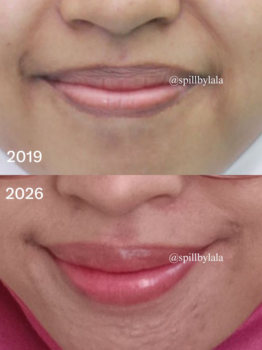 spillbylala's tweet photo. PURE PAW PAW!!! 😭🫶🏻
Dulu bibirku selalu kering, ngelupas, pinggirannya gelap. Setelah nemu pure paw paw dan rutin pake tiap malam, akhirnya udah ga pernah kering, DAN... BONUSNYA BIBIR JADI LEBIH CERAH

*pict 2 itu cuma pake lip balm ga ada warnanya tp di bibirku kelihatan seger https://t.co/iZVVFDzhus