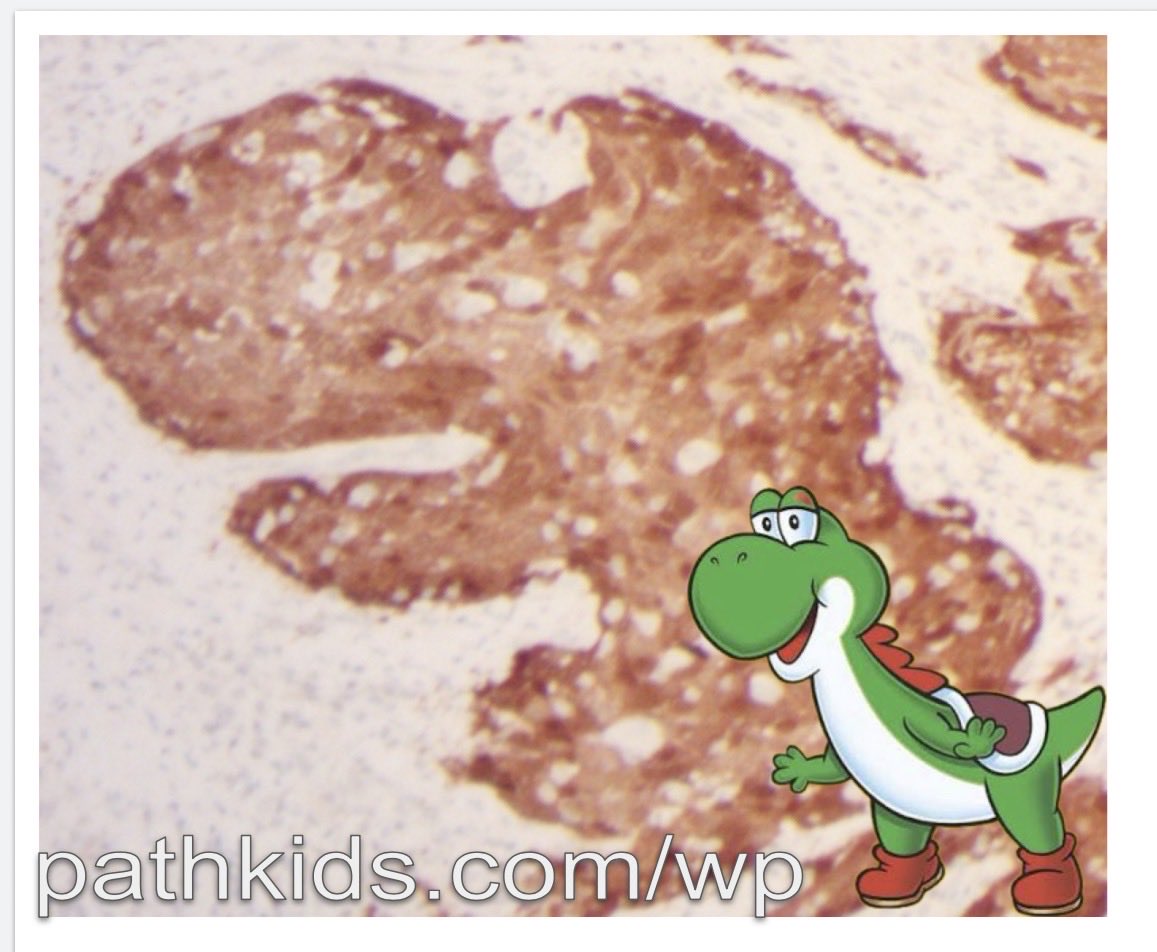 drtimbracey's tweet photo. Ancient reptiles are not a recognised feature of HPV-associated oropharyngeal SCC but this seems to be a rare example of p16+ SCC with incidental baby dinosaur differentiation #pathart #ENTpath @kriyer68 @pathkids https://t.co/ZD93ZIBhtd