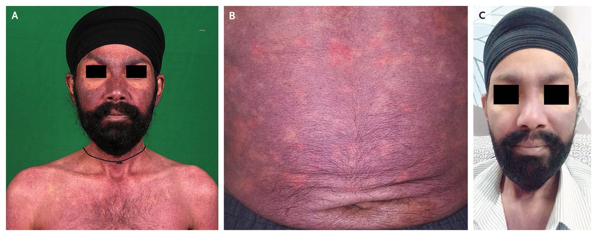 NEJM's tweet photo. Images in Clinical Medicine: Flushing in Carcinoid Syndrome https://t.co/B2wQLpveHu

#Oncology #Endocrinology https://t.co/ySaL2gwZac