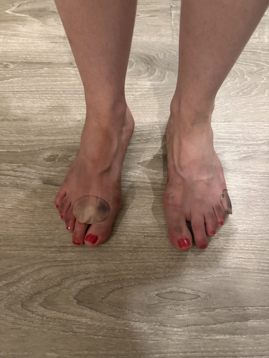itsmenorapf's tweet photo. I wear heels a lot so my feet are quite bruised. Who wants to buy? #feet #feetfetısh #feetworshi̇p #feetpics #feetbuyer #feetbuyer #feetwoman #feetformen #feetme https://t.co/O1HAXZRs2P
