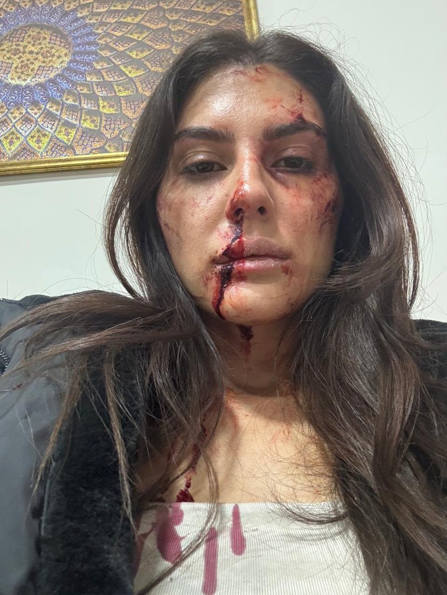 WealthEmpireX's tweet photo. Injury marks on actress #ElnaazNorouzi face https://t.co/uvJ6fgoGaq