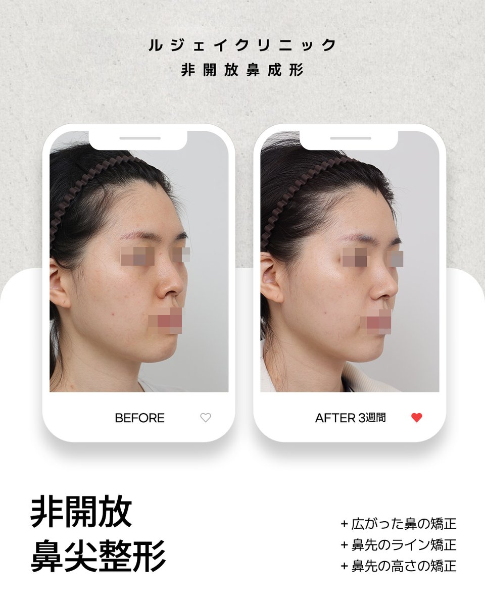lejclinic's tweet photo. ルジェイクリニックのクローズ法による鼻尖形成は、鼻柱の外側を切開せず、鼻の内側からアプローチし、一人ひとり異なる鼻先の軟骨構造や支持力を考慮しながら、正面と横顔の両方で調和のとれた鼻先のラインをデザインすることで、高い満足感を目指しています。#韓国鼻整形 #ダウンタイムが短い鼻整形 https://t.co/AQj0W9ChtO