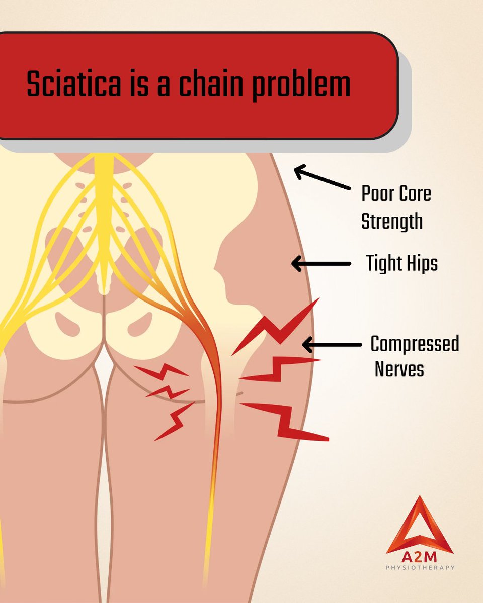 Aim2MovePhysio's tweet photo. Sciatica isn't a diagnosis, it's a symptom. The pain runs down your leg, but the source is rarely just your lower back.

If you're looking for a deeper evaluation, make sure to connect with us today!  

#Sciatica #PhysicalTherapist #HolisticHealth #FlowerMoundPT #FloMoPT https://t.co/r33zWhvm5W