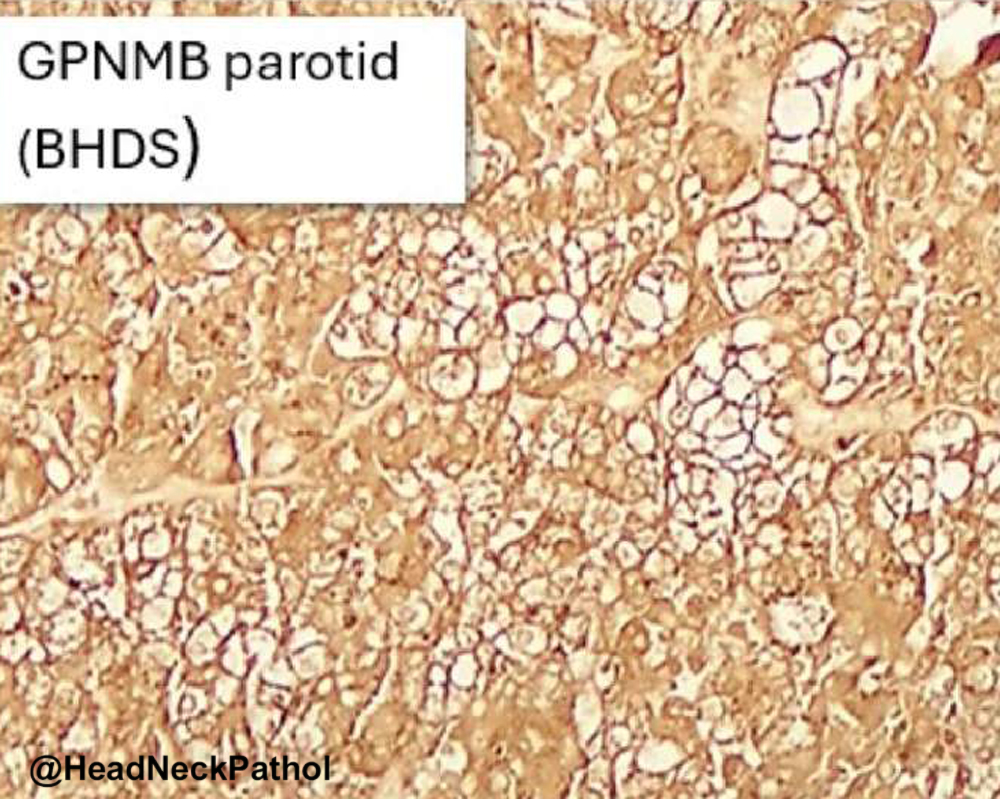 HeadNeckPathol's tweet photo. Parotid Oncocytomas Express the Glycoprotein Non-metastatic Melanoma Protein B (GPNMB): A Potential Link with Birt-Hogg-Dubé Syndrome
A Peraza-Labrador, J Bishop, LS Schmidt, et al
https://t.co/fsMcQIBeZx
#HeadNeckPathol #HNPJ #HeadandNeckPath #Pathology #ENTPath #PathologyTweet https://t.co/sVTYqINlSa