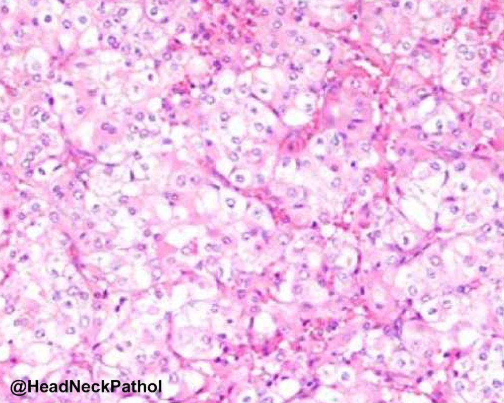 HeadNeckPathol's tweet photo. Parotid Oncocytomas Express the Glycoprotein Non-metastatic Melanoma Protein B (GPNMB): A Potential Link with Birt-Hogg-Dubé Syndrome
A Peraza-Labrador, J Bishop, LS Schmidt, et al
https://t.co/fsMcQIBeZx
#HeadNeckPathol #HNPJ #HeadandNeckPath #Pathology #ENTPath #PathologyTweet https://t.co/sVTYqINlSa