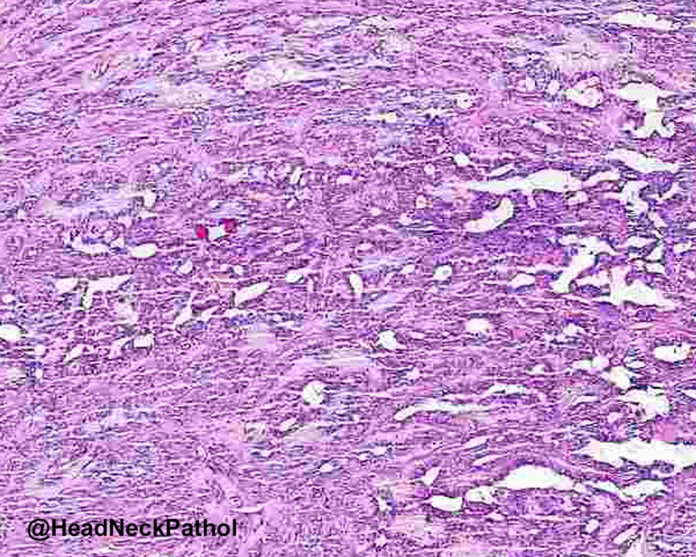 HeadandNeckPath's tweet photo. Extensive Bone Destruction, Lymphovascular and Perineural Invasion, and Local Recurrence: Unusual Features in Salivary Gland Microsecretory Adenocarcinoma
Aanchal Kakkar, et al
https://t.co/tnjBrDfShW
#HeadNeckPathol #HNPJ #HeadandNeckPath #Pathology #ENTPath #PathologyTweet https://t.co/GAk5IQpEcA