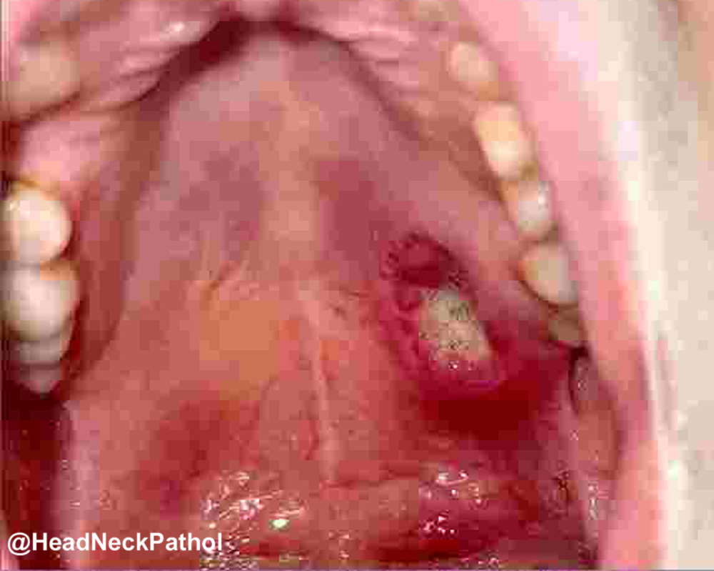 HeadandNeckPath's tweet photo. Extensive Bone Destruction, Lymphovascular and Perineural Invasion, and Local Recurrence: Unusual Features in Salivary Gland Microsecretory Adenocarcinoma
Aanchal Kakkar, et al
https://t.co/tnjBrDfShW
#HeadNeckPathol #HNPJ #HeadandNeckPath #Pathology #ENTPath #PathologyTweet https://t.co/GAk5IQpEcA