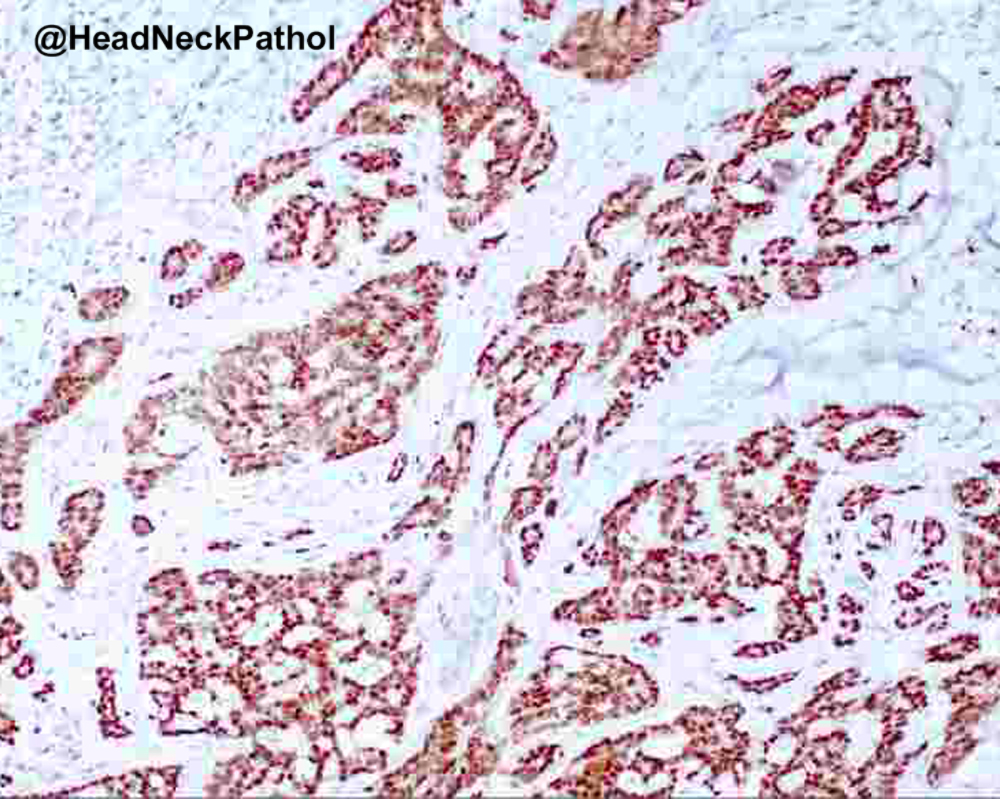 HeadandNeckPath's tweet photo. Extensive Bone Destruction, Lymphovascular and Perineural Invasion, and Local Recurrence: Unusual Features in Salivary Gland Microsecretory Adenocarcinoma
Aanchal Kakkar, et al
https://t.co/tnjBrDfShW
#HeadNeckPathol #HNPJ #HeadandNeckPath #Pathology #ENTPath #PathologyTweet https://t.co/GAk5IQpEcA