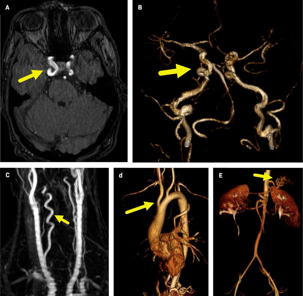 Applied_Rad's tweet photo. Loeys-Dietz syndrome  👀 Would you know what to look for? 

Learn more:  https://t.co/8PTItYLtQN 

Loeys-Dietz syndrome (LDS) is a rare connective tissue disorder typically caused by mutations in 1 of 6 different genes.  

#radiology #RadEd #MedEd #RadiologyEducation https://t.co/fRIAKJxjhB
