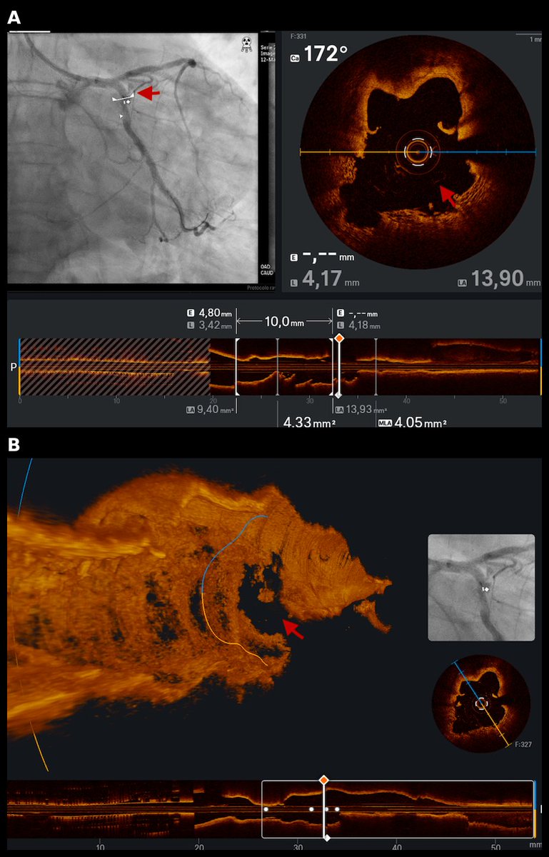 InvasiveCardiol's tweet photo. 🔎From the Coronary Imaging Topic Center: Capturing Coronary Artery Perforation on OCT—A Rare Imaging Record After Excimer Laser Atherectomy of a Calcified Nodule

https://t.co/037JwiuxsK

@DegrandeLagosDr @DLBHATTMD #cardioTwitter #cardioX #cardiology #interventionalcardiology https://t.co/DJmyVWAgWY