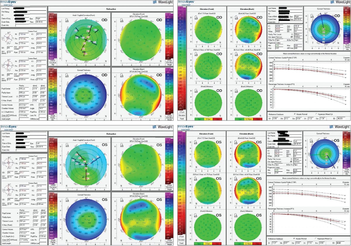 revoptom's tweet photo. Secrets of the Surface: Epithelial Mapping in Clinical Practice

In this feature, Mitch Ibach, OD, and Samantha Rivet, OD, highlight patient cases where this technology can identify subtle ectasia before more prominent changes occur: https://t.co/xn3iMvLW4W

#optometry #eyecare #optometrist #ectasia #cornea