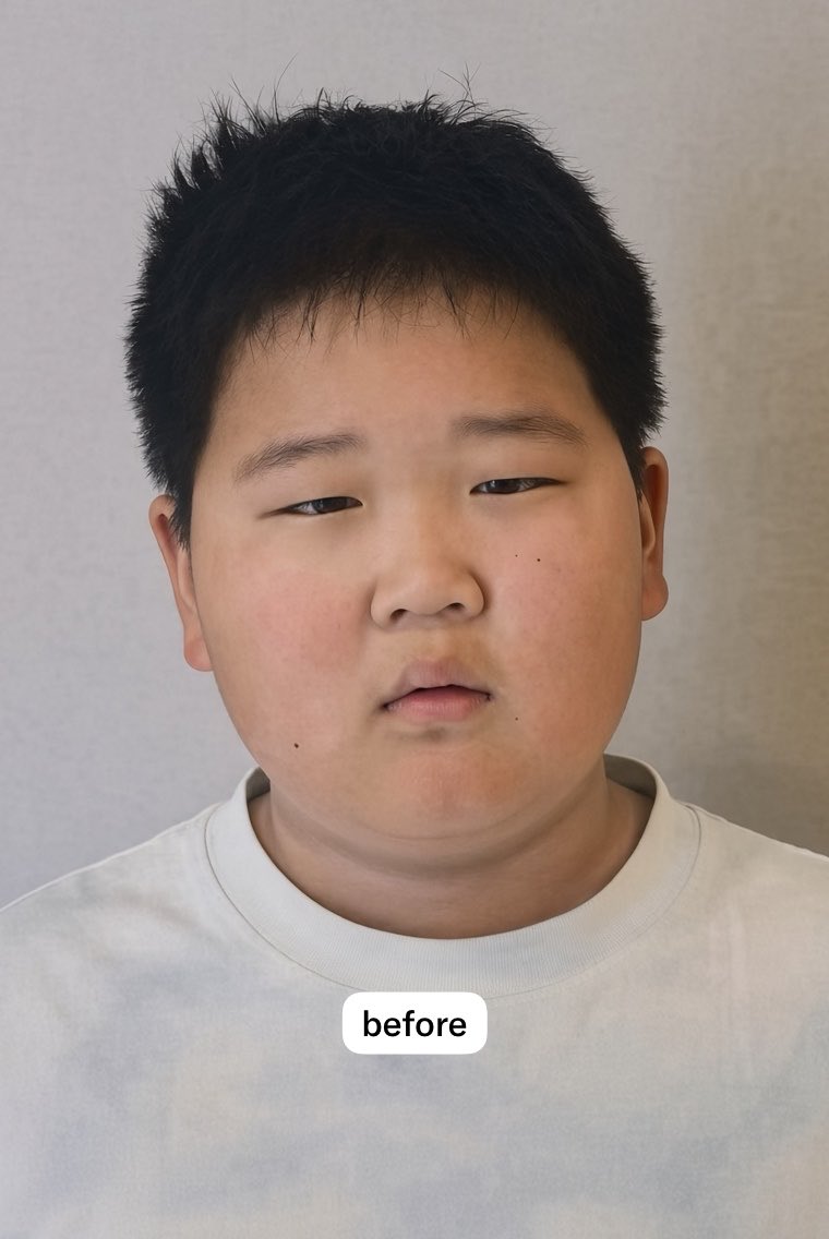mtgjdpa's tweet photo. 【悲報】中国整形さん、11歳に二重全切開＋眼瞼下垂手術の幼児虐待を行い炎上する

TCBが小学生に二重整形モニターをやって週刊誌に報道にされた事件が記憶に新しいが、今回は埋没法ではない後戻りできない全切開だ。

瞼の形は大人になるまでに変わっていく事が想定されるので、小学生中学生で目頭切開や全切開させるのは親の責任放棄だと思ってる。