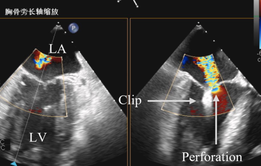 CraigBasman's tweet photo. Fantastic issue @JACCJournals #JACCcasereports with a bit of everything from around the world.
One of the best cases I reviewed came out of Guangzhou, China..
Delayed perforation of anterior leaflet in a patient with prior m-TEER for FMR..
With clip in place, they crossed and plugged. (We have done this and rapid paced to make easier for straight glidewire to cross).