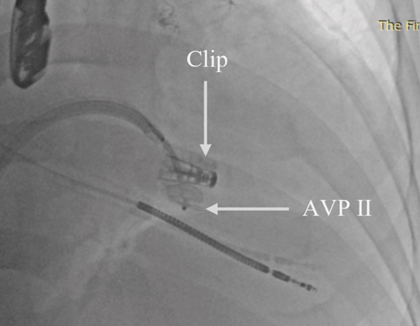 CraigBasman's tweet photo. Fantastic issue @JACCJournals #JACCcasereports with a bit of everything from around the world.
One of the best cases I reviewed came out of Guangzhou, China..
Delayed perforation of anterior leaflet in a patient with prior m-TEER for FMR..
With clip in place, they crossed and plugged. (We have done this and rapid paced to make easier for straight glidewire to cross).