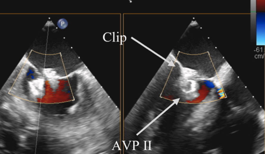 CraigBasman's tweet photo. Fantastic issue @JACCJournals #JACCcasereports with a bit of everything from around the world.
One of the best cases I reviewed came out of Guangzhou, China..
Delayed perforation of anterior leaflet in a patient with prior m-TEER for FMR..
With clip in place, they crossed and plugged. (We have done this and rapid paced to make easier for straight glidewire to cross).
