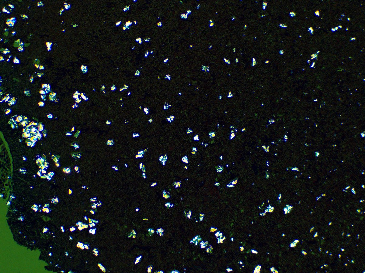 Arshi_Asma's tweet photo. π Trick or treat: Fungus or crystals?
Fungal ball with striking oxalate crystal deposition. The organisms are diagnostic, but the birefringent crystals are the real showstoppers. Anyone else love when pathology delivers both a diagnosis and a light show? π€©β¨π¬
Β #PathTwitter https://t.co/vstqX1yFPa