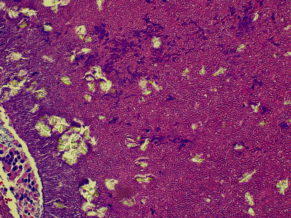 Arshi_Asma's tweet photo. π Trick or treat: Fungus or crystals?
Fungal ball with striking oxalate crystal deposition. The organisms are diagnostic, but the birefringent crystals are the real showstoppers. Anyone else love when pathology delivers both a diagnosis and a light show? π€©β¨π¬
Β #PathTwitter https://t.co/vstqX1yFPa