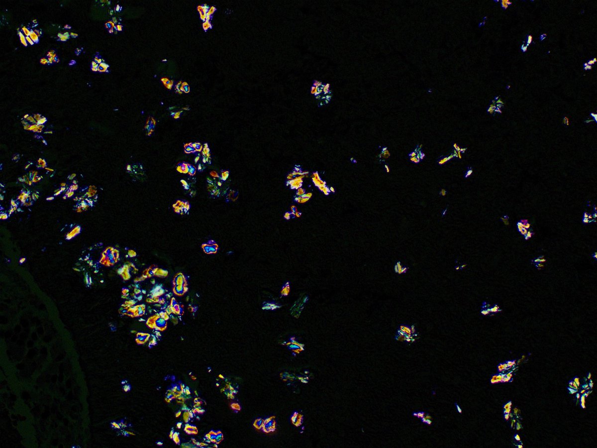 Arshi_Asma's tweet photo. π Trick or treat: Fungus or crystals?
Fungal ball with striking oxalate crystal deposition. The organisms are diagnostic, but the birefringent crystals are the real showstoppers. Anyone else love when pathology delivers both a diagnosis and a light show? π€©β¨π¬
Β #PathTwitter https://t.co/vstqX1yFPa